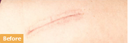 Surgery Scars